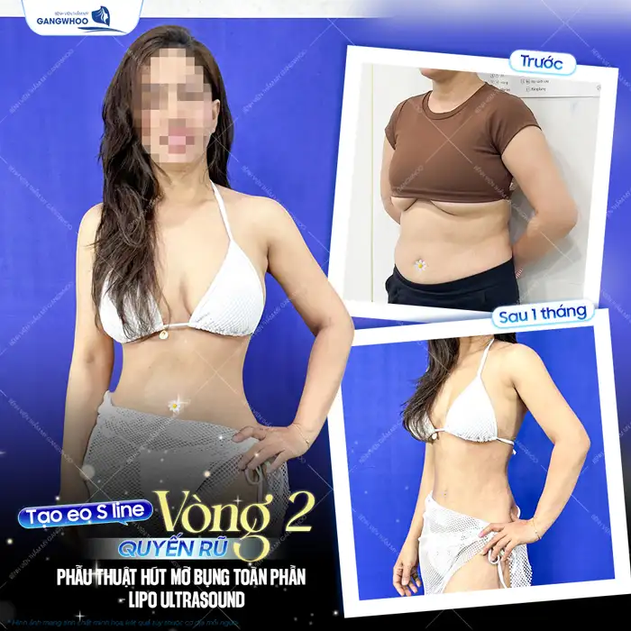 Chia sẻ kinh nghiệm đi hút mỡ để đảm bảo an toàn, hiệu quả