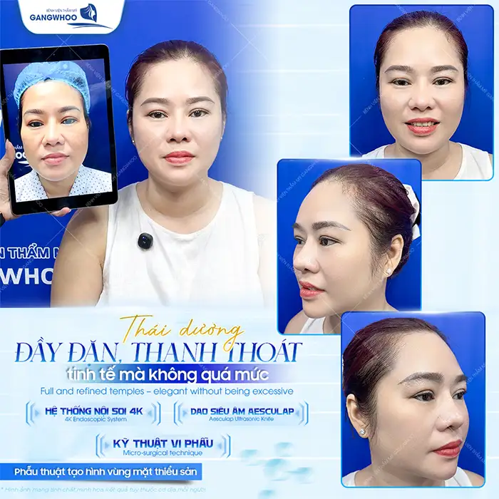 Chườm đá có hạ gò má không? Có hiệu quả như lời đồn không?
