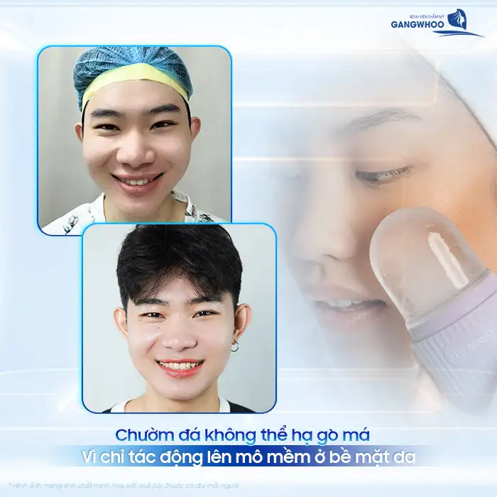 Chườm đá có hạ gò má không? Có hiệu quả như lời đồn không?