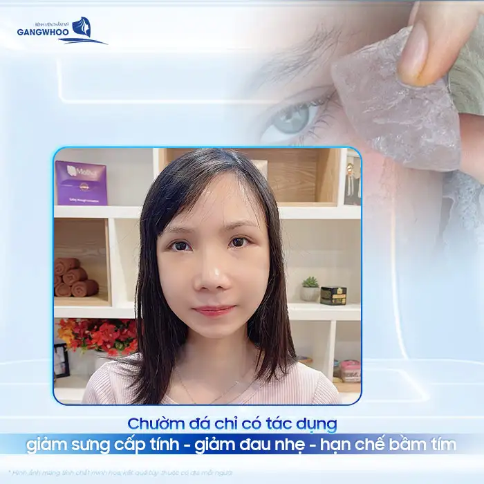 Chườm đá có hạ gò má không? Có hiệu quả như lời đồn không?