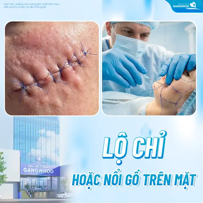 Có nên căng chỉ da mặt không? Những lưu ý trước khi thực hiện