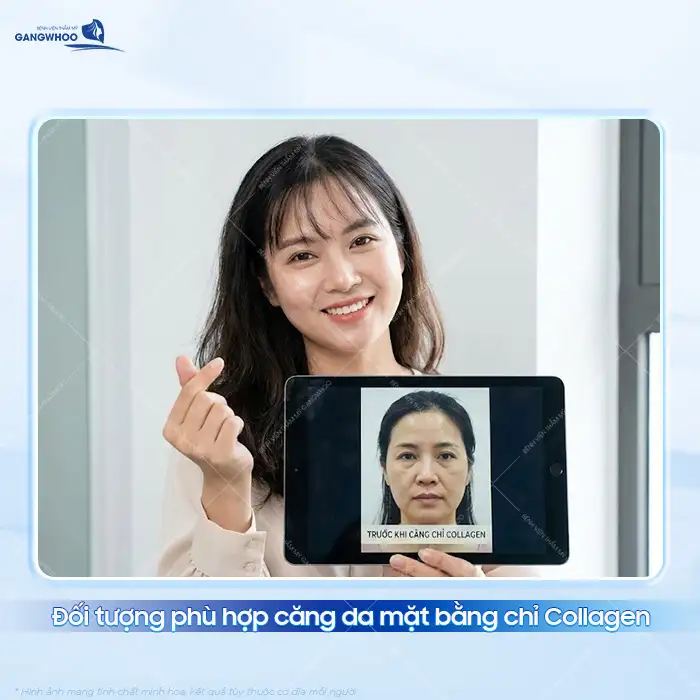 Có nên căng da mặt bằng chỉ Collagen? Ưu, nhược điểm của chỉ Collagen