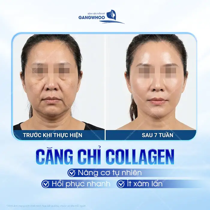 Có nên căng da mặt bằng chỉ Collagen? Ưu, nhược điểm của chỉ Collagen