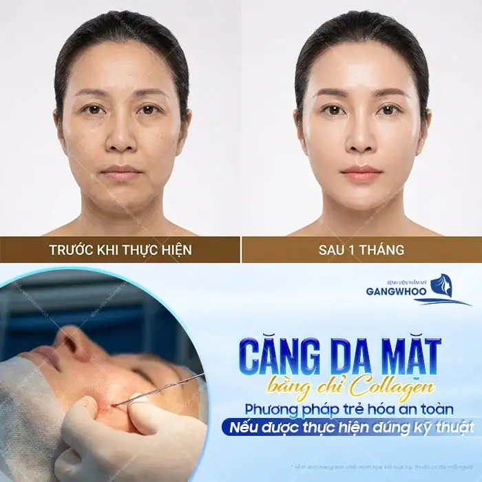 Có nên căng da mặt bằng chỉ Collagen? Ưu, nhược điểm của chỉ Collagen