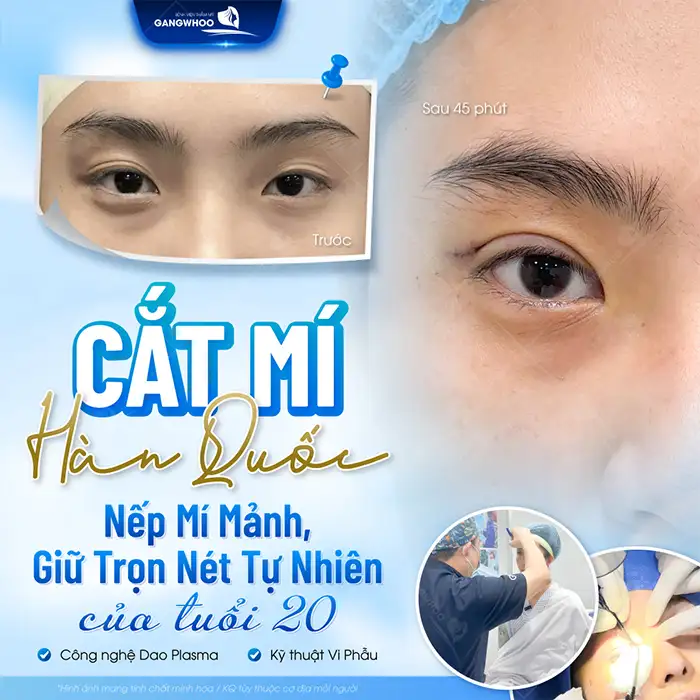 Có nên cắt mí mắt không? Cần lưu ý những gì trước khi thực hiện?