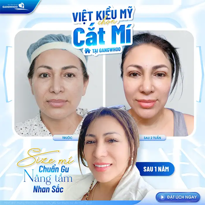 Có nên cắt mí mắt không? Cần lưu ý những gì trước khi thực hiện?