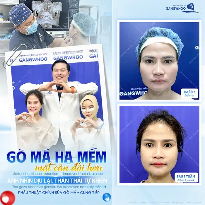 Có nên hạ gò má bằng phương pháp bấm huyệt? Liệu có hiệu quả?