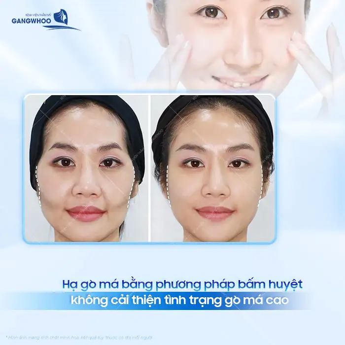 Có nên hạ gò má bằng phương pháp bấm huyệt? Liệu có hiệu quả?