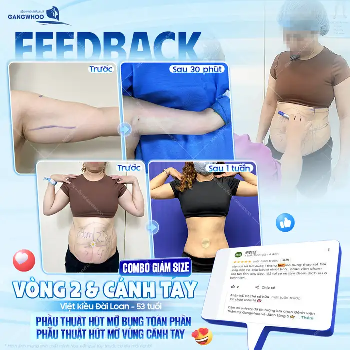 Có nên hút mỡ bụng sau sinh không? Bác sĩ tư vấn thời điểm phù hợp