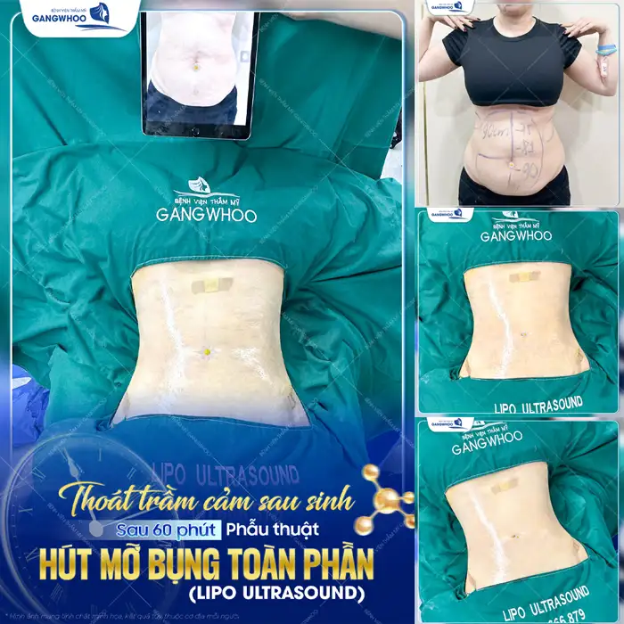 Có nên hút mỡ bụng sau sinh không? Bác sĩ tư vấn thời điểm phù hợp