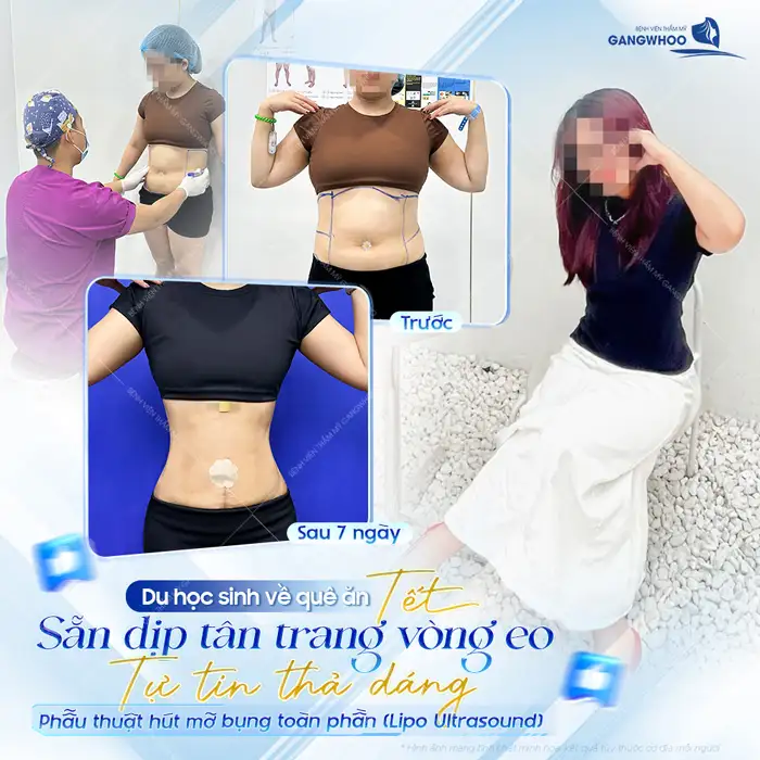 Có nên hút mỡ bụng sau sinh không? Bác sĩ tư vấn thời điểm phù hợp