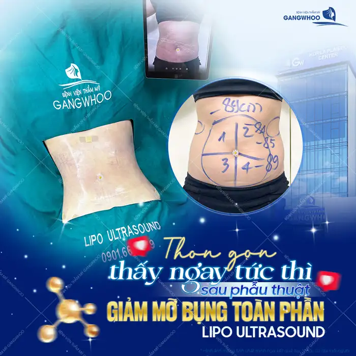 Có nên hút mỡ bụng sau sinh không? Bác sĩ tư vấn thời điểm phù hợp