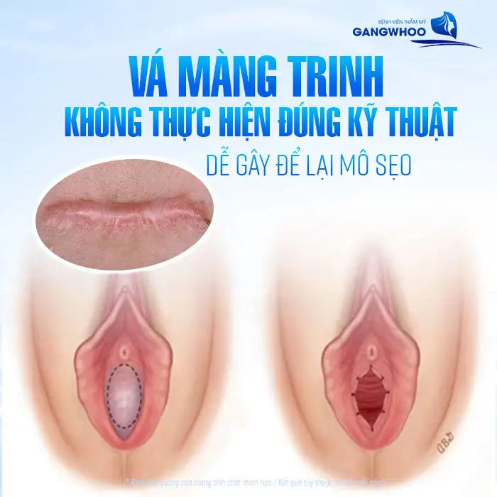 Có nên vá màng trinh không? Những lợi ích khi vá màng trinh