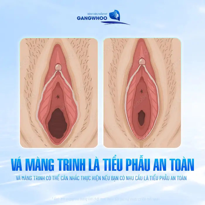 Có nên vá màng trinh không? Những lợi ích khi vá màng trinh