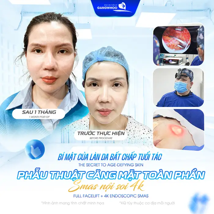 Căng da mặt bằng công nghệ Hifu là gì? Ưu, nhược điểm của phương pháp