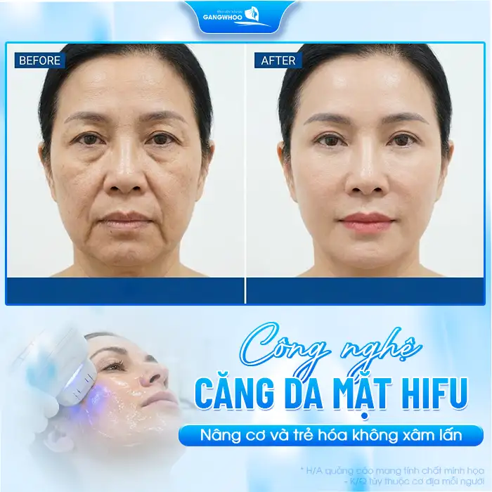 Căng da mặt bằng công nghệ Hifu là gì? Ưu, nhược điểm của phương pháp