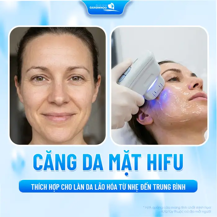 Căng da mặt bằng công nghệ Hifu là gì? Ưu, nhược điểm của phương pháp