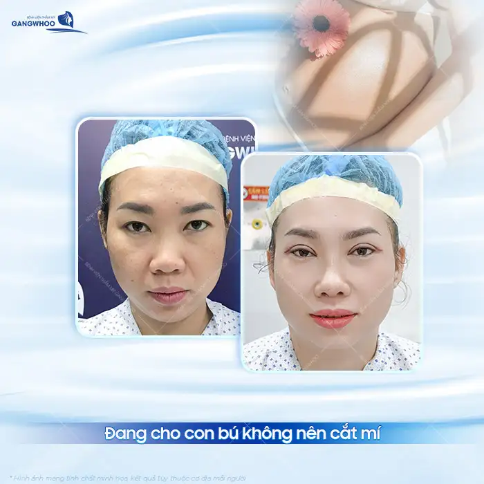 Đang cho con bú có cắt mí được không? Có ảnh hưởng gì không?