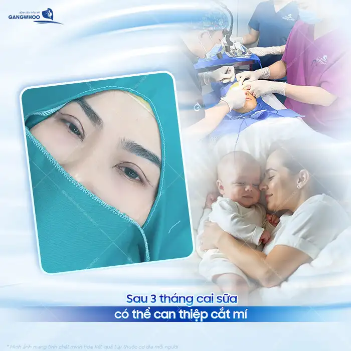 Đang cho con bú có cắt mí được không? Có ảnh hưởng gì không?