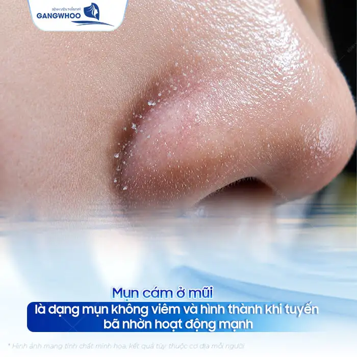 Tham khảo cách điều trị mụn cám ở mũi an toàn, đơn giản