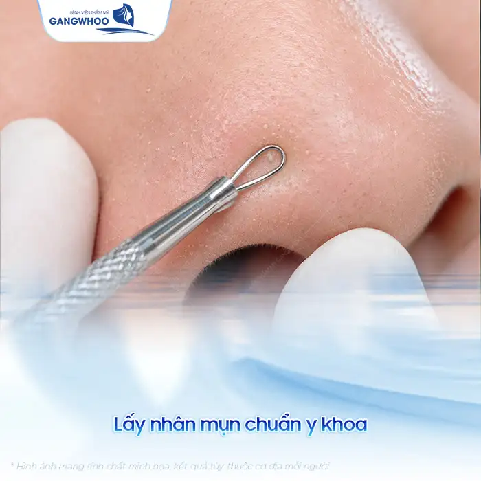 Tham khảo cách điều trị mụn cám ở mũi an toàn, đơn giản