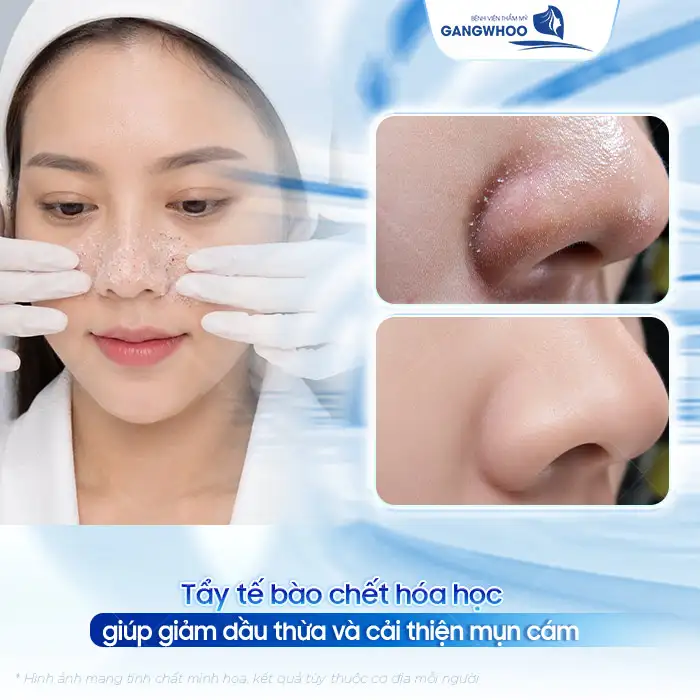 Tham khảo cách điều trị mụn cám ở mũi an toàn, đơn giản