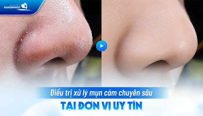 Cách điều trị mụn cám tại nhà hiệu quả nhanh, an toàn cho da