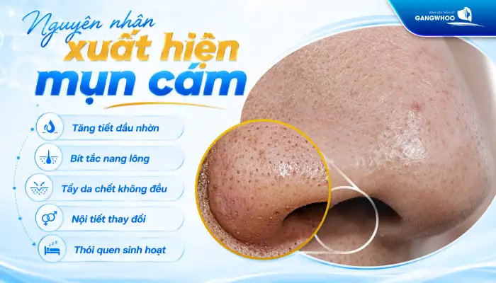 Cách điều trị mụn cám tại nhà hiệu quả nhanh, an toàn cho da