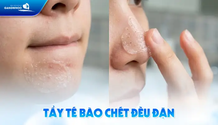 Cách điều trị mụn cám tại nhà hiệu quả nhanh, an toàn cho da