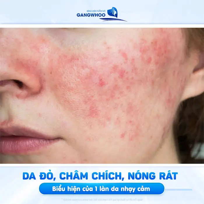 Cách điều trị mụn cho da nhạy cảm tránh gây kích ứng da