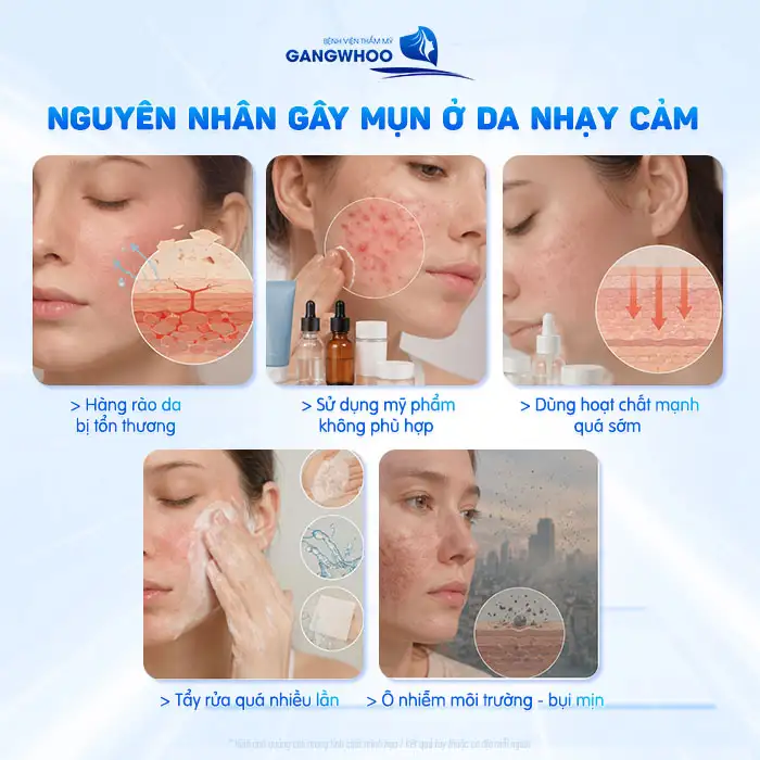 Cách điều trị mụn cho da nhạy cảm tránh gây kích ứng da