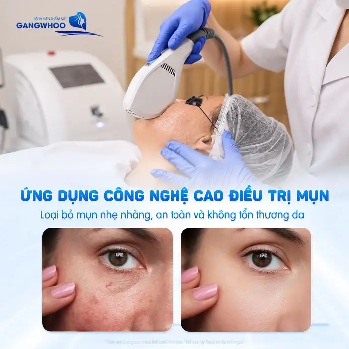 Cách điều trị mụn cho da nhạy cảm tránh gây kích ứng da