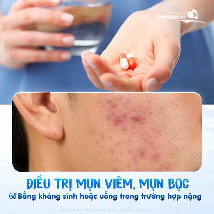 Có nên điều trị mụn cho nam giới? Phương pháp nào hiệu quả