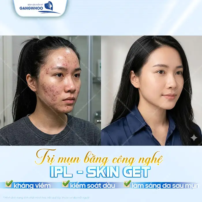 Điều trị mụn chuyên sâu là gì? Quy trình bao gồm mấy bước?
