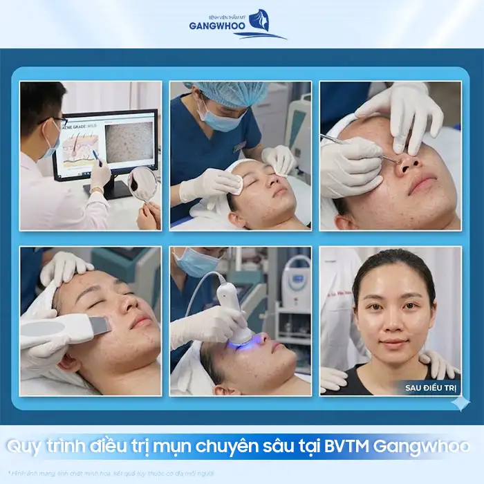 Điều trị mụn chuyên sâu là gì? Quy trình bao gồm mấy bước?