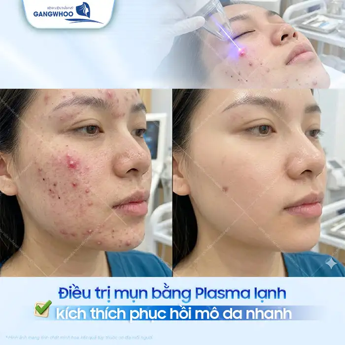Điều trị mụn chuyên sâu là gì? Quy trình bao gồm mấy bước?