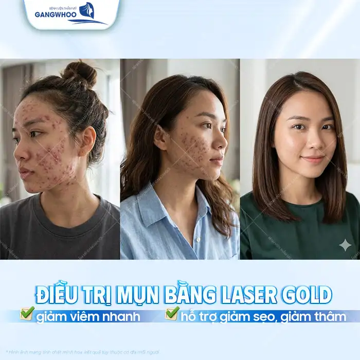 Điều trị mụn chuyên sâu là gì? Quy trình bao gồm mấy bước?