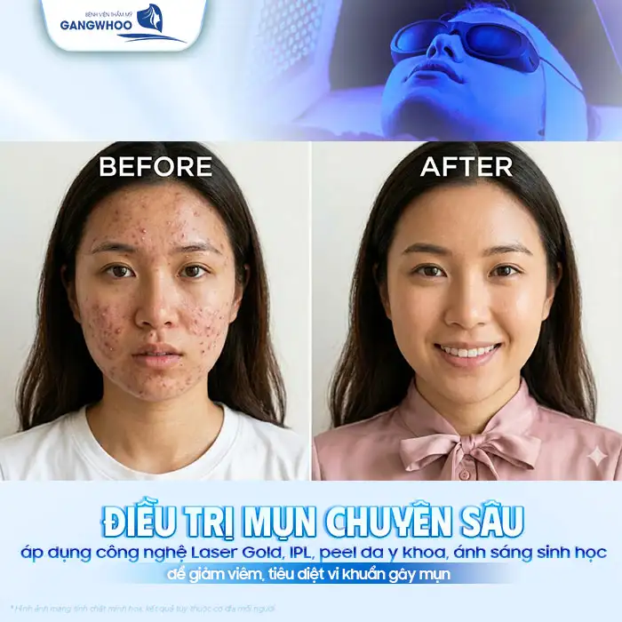 Điều trị mụn chuyên sâu là gì? Quy trình bao gồm mấy bước?