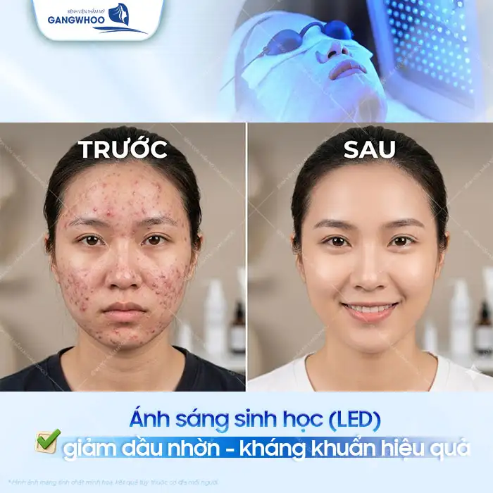 Điều trị mụn chuyên sâu là gì? Quy trình bao gồm mấy bước?