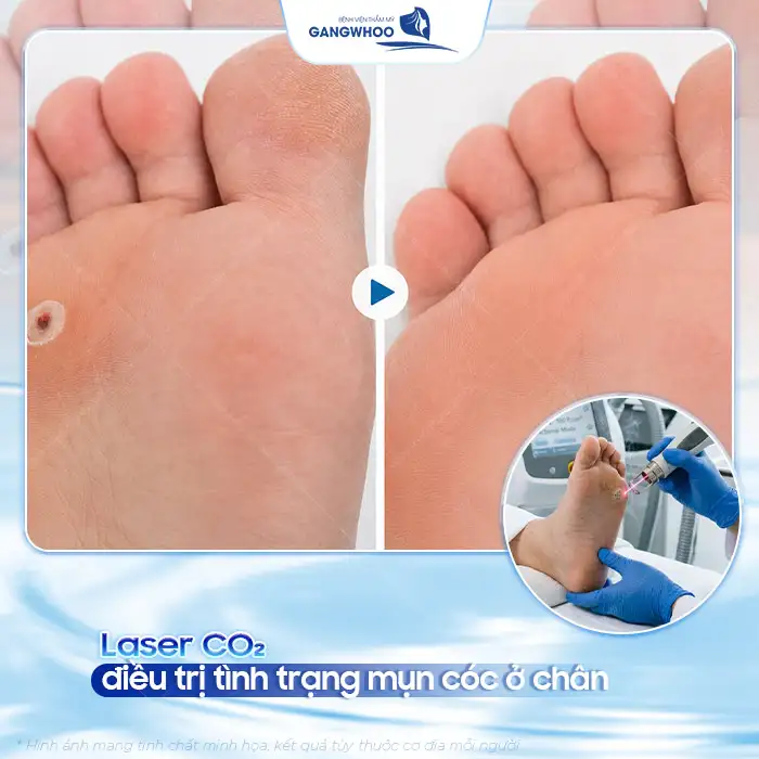 Cách điều trị mụn cóc ở chân đúng cách để tránh lây lan, tái phát