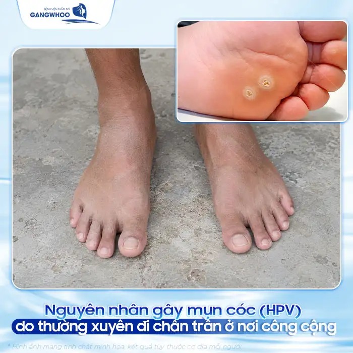Cách điều trị mụn cóc ở chân đúng cách để tránh lây lan, tái phát