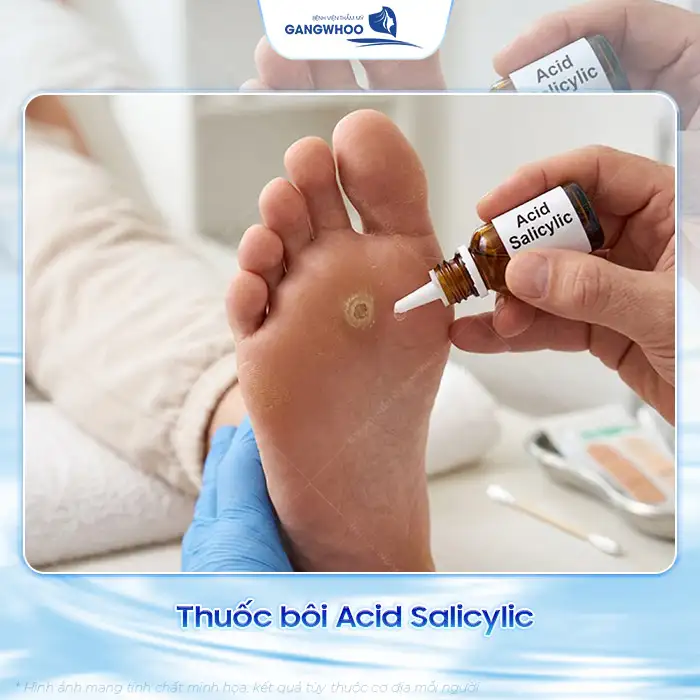 Cách điều trị mụn cóc ở chân đúng cách để tránh lây lan, tái phát