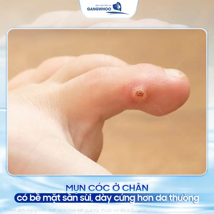 Cách điều trị mụn cóc ở chân đúng cách để tránh lây lan, tái phát