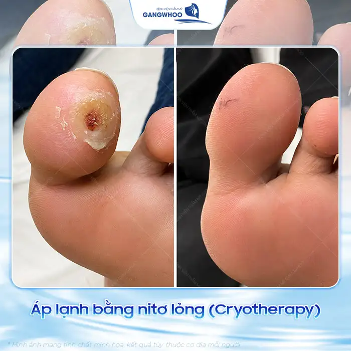Cách điều trị mụn cóc ở chân đúng cách để tránh lây lan, tái phát
