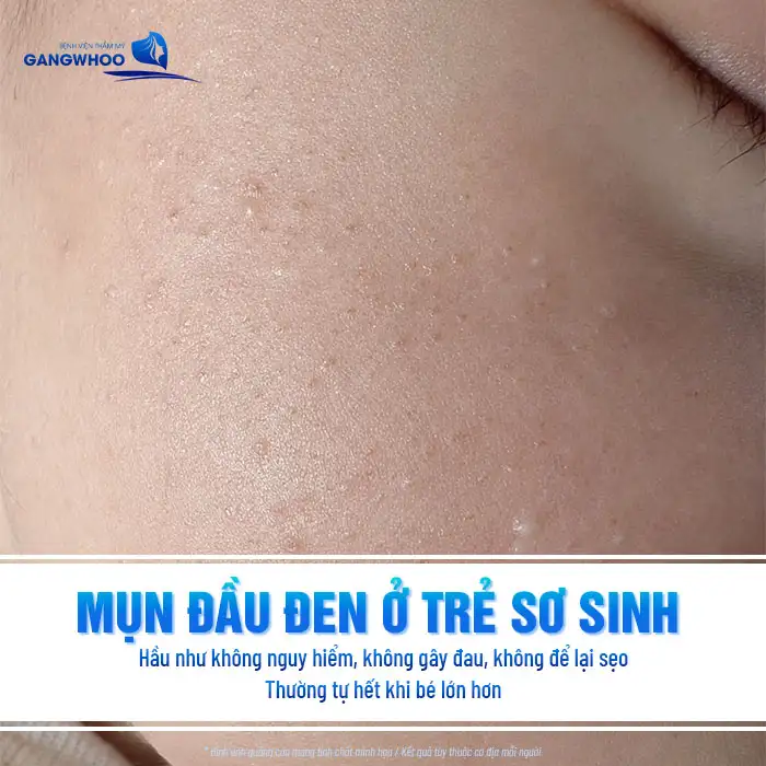 Cách điều trị mụn đầu đen ở trẻ sơ sinh ra sao? Cần lưu ý những gì?