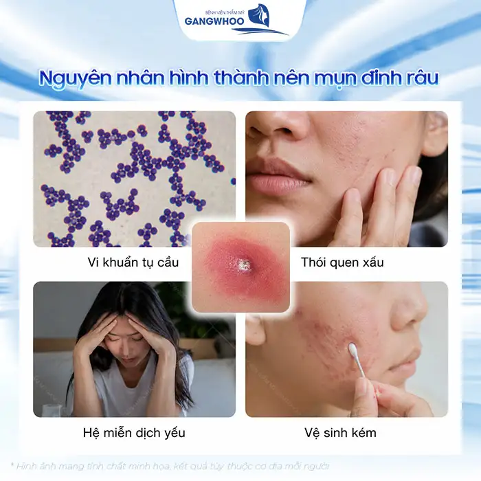 Cách điều trị mụn đinh râu an toàn, tránh biến chứng nguy hiểm