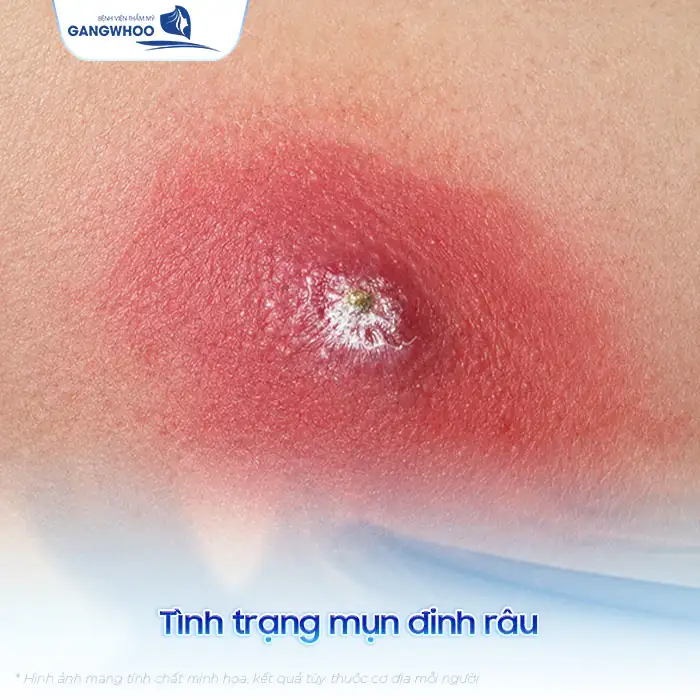 Cách điều trị mụn đinh râu an toàn, tránh biến chứng nguy hiểm