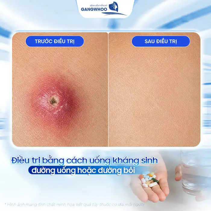 Cách điều trị mụn đinh râu an toàn, tránh biến chứng nguy hiểm