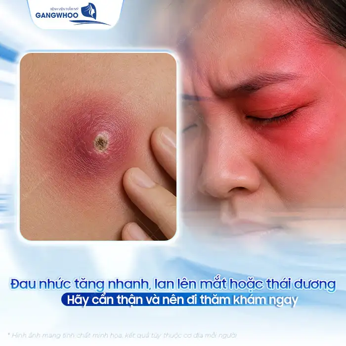 Cách điều trị mụn đinh râu an toàn, tránh biến chứng nguy hiểm