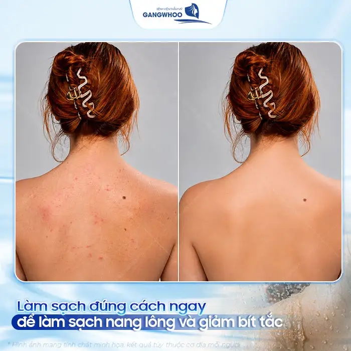 Phác đồ điều trị mụn lưng và viêm nang lông hiệu quả, an toàn